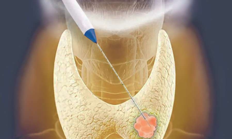 Brain and Spinal AVMs – Embolisation