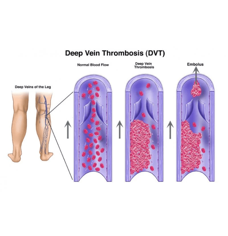 DVT Thrombectomy
