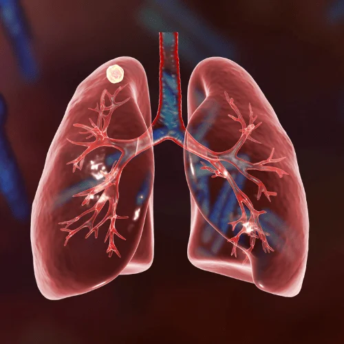 Pulmonary Interventions